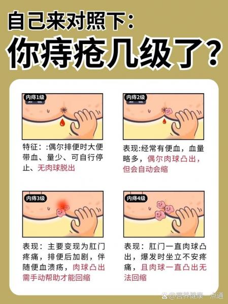 为什么尽量不割痔疮，女性割痔疮的最佳时间
